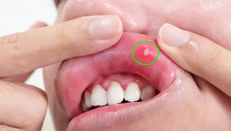 B Vitamini Eksikliğinin Beş Belirgin İşareti: Sağlığınızı Koruyun